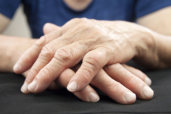 Hand Of Woman Deformed From Rheumatoid Arthritis