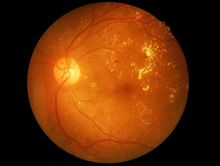 retina of a person with diabetic retinopathy